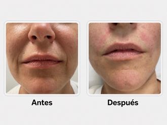 Ácido hialurónico antes y después - 879703