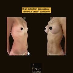 High-definition liposuction + Tuberous breast correction