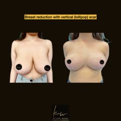 Breast reduction with vertical (lollipop) scar