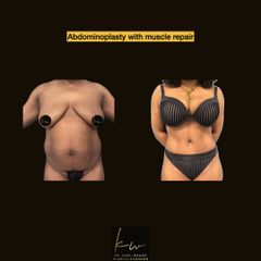 Abdominoplasty with muscle repair