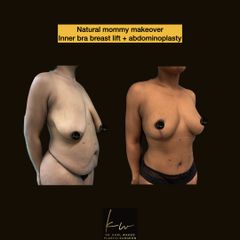 Natural mommy makeover: Inner bra breast lift + abdominoplasty