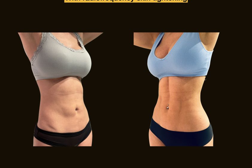 Lipoescultura antes y después - 873819