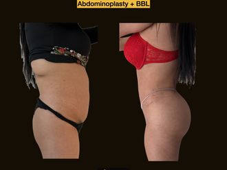 Aumento glúteos antes y después - 873820