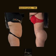 Abdominoplasty + BBL