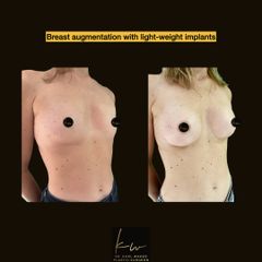 Breast augmentation with light-weight implants