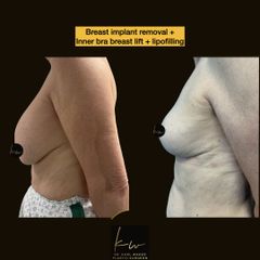 Breast implant removal + Inner bra breast lift + lipofilling