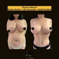 Mommy makeover Breast reduction + 360° liposuction + abdominoplasty