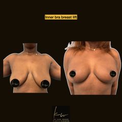 Inner bra breast lift