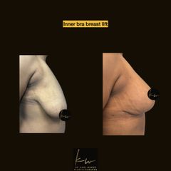 Inra bra breast lift