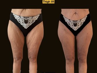 Cirugía reconstructiva antes y después - 873831
