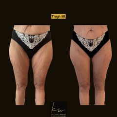 Thigh lift