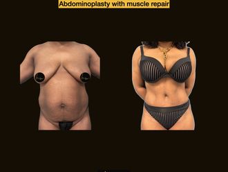 Abdominoplastia antes y después - 875203