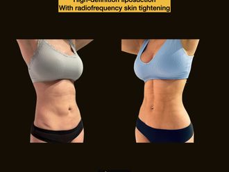Liposucción antes y después - 875207