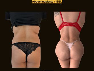 Abdominoplastia antes y después - 875209