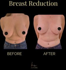 Dr. Karl Waked - Breast Reduction
