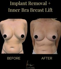 Dr. Karl Waked - Implant Removal
