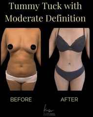 Dr. Karl Waked - Tummy Tuck