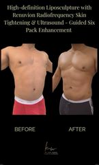 Dr. Karl Waked - High-definition Liposculture