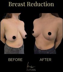 Dr. Karl Waked - Breast Reduction