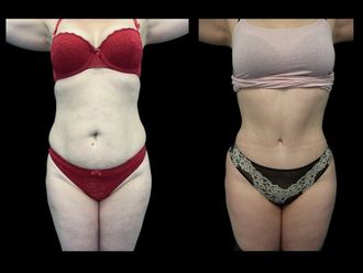 Abdominoplastia antes y después - 875576