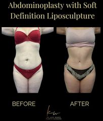Dr. Karl Waked - Abdominoplasty