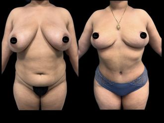 Abdominoplastia antes y después - 875577