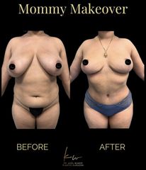 Dr. Karl Waked - Mommy Makeover
