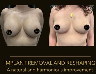 Dr. Karl Waked - Implant Removal