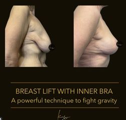 Dr. Karl Waked - Breast Lift
