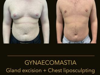 Ginecomastia antes y después - 875582