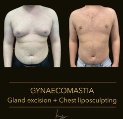 Dr. Karl Waked - Gynaecomastia