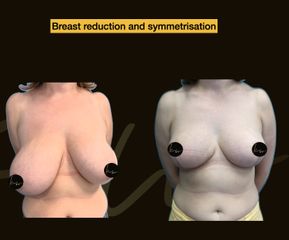 Dr. Karl Waked - Breast Reduction