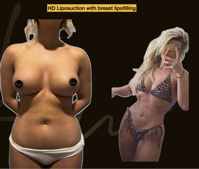 Dr. Karl Waked - Liposuction