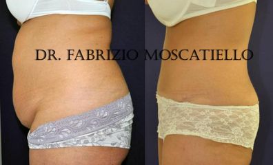 Antes y después Abdominoplastia