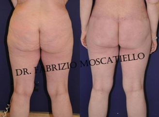 Antes y después Liposucción
