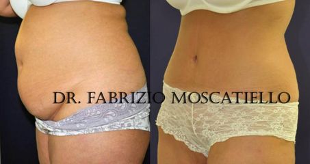 Antes y después abdominoplastia