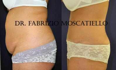 Antes y después abdominoplastia