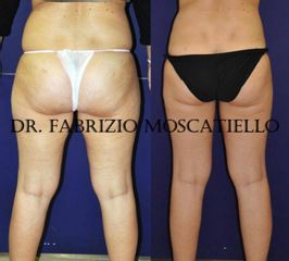 Antes y después lipoescultura
