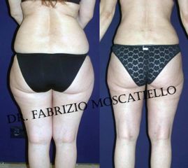 Antes y después lipoescultura