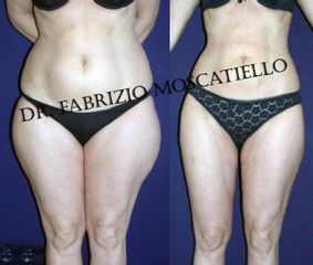 Antes y después liposucción