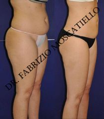 Antes y después liposucción