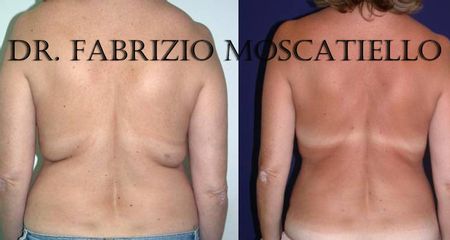 Antes y después Liposucción espalda