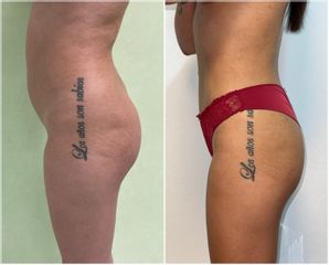 Liposucción - Clínica Dr. Arán