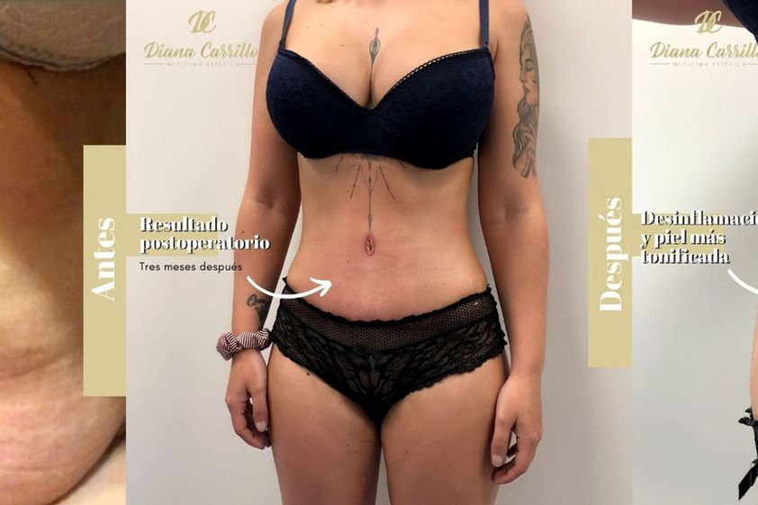 Drenaje linfático antes y después - 793615