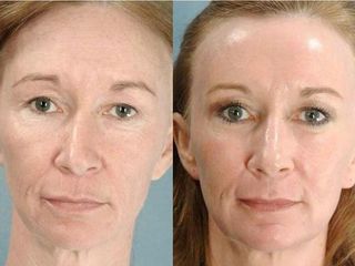 Antes y después Radiofrecuencia facial