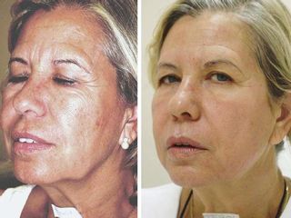 Antes y después Radiofrecuencia facial