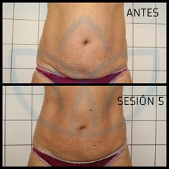 Celulitis - Clínicas Inneo