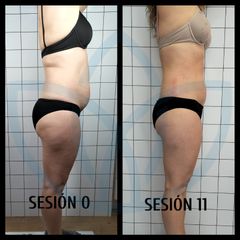 Celulitis - Clínicas Inneo