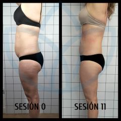 Celulitis - Clínicas Inneo