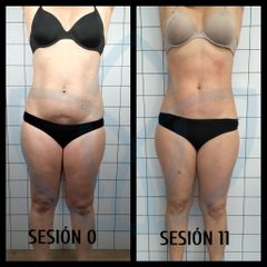 Celulitis - Clínicas Inneo
